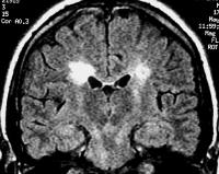 Lesions